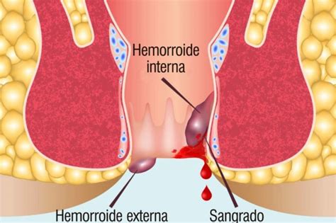 Hemorroides o almorranas: tipos, tratamientos y fotos